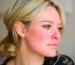 Rosacea Bashratycare