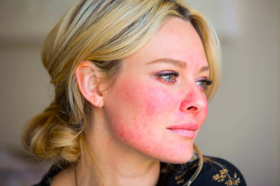 Rosacea Bashratycare